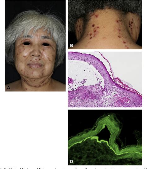 Figure 1 From A Case Of Epidermolysis Bullosa Acquisita With Clinical
