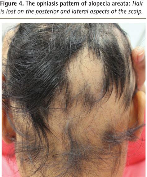 Diffuse alopecia areata is a sudden thinning of your hair rather than lost patches. Alopecia areata | The College of Family Physicians of Canada