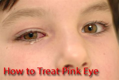 Below is some additional information about lasik at every age. How to Treat Pink Eye (With Photos) | HubPages