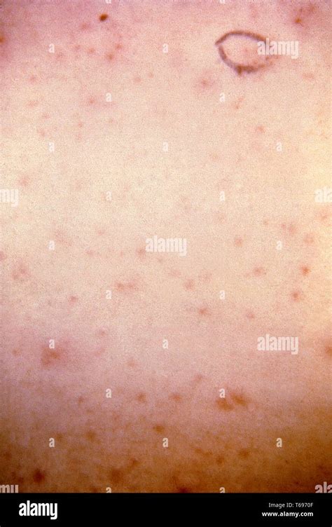Close Up Photograph Of The Typical Skin Rash Caused By The Sarcoptes