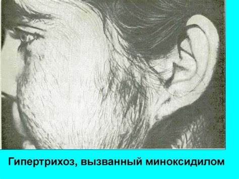 Гирсутизм и диета