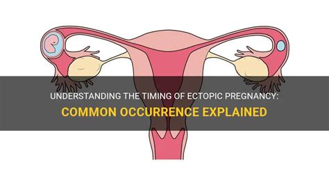 Understanding The Timing Of Ectopic Pregnancy Common Occurrence