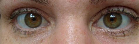 Darkened Sclera Whites Of The Eyes During Accutane Prescription