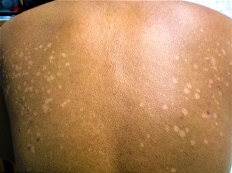 Tinea Versicolor Causes Signs Symptoms Treatment And Remedies