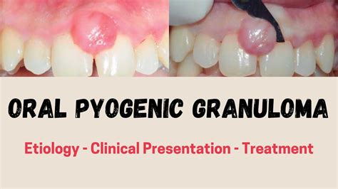 Oral Pyogenic Granuloma Etiology Clinical Presentation Treatment