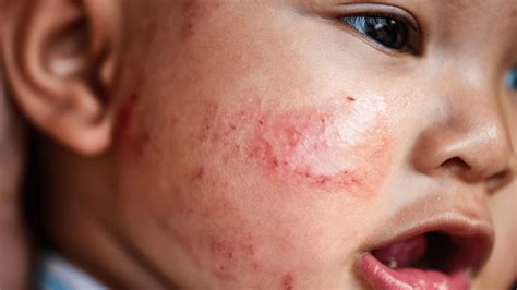 Eczema The Itch That Rashes