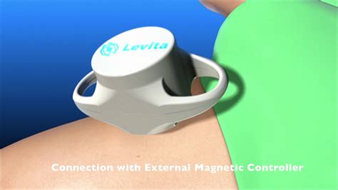 Levita Magnetics Announces Worlds First Magnetic Scarless Robotic