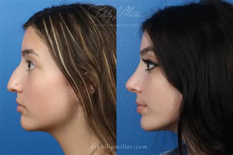 Surgical Or Liquid Non Surgical Rhinoplasty Which One Is Right For