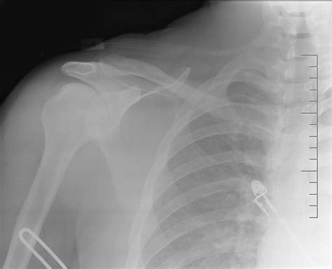 Dislocated Shoulder X Ray Flickr Photo Sharing