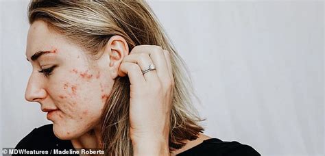 Woman With Cystic Acne Feared She Was Unlovable Due To Scarred Skin