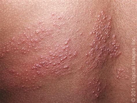 Shingles As Related To Skin Pictures