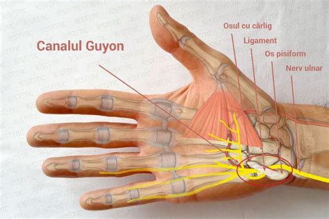 Sindromul De Canal Guyon Cu Compresia Nervului Ulnar Tratament