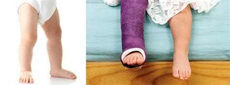 How To Care For Your Child With Toddlers Fracture Sidra Medicine