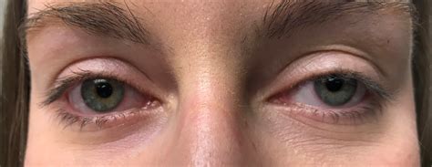 Why Do I Have Ptosis A Drooping Eyelid