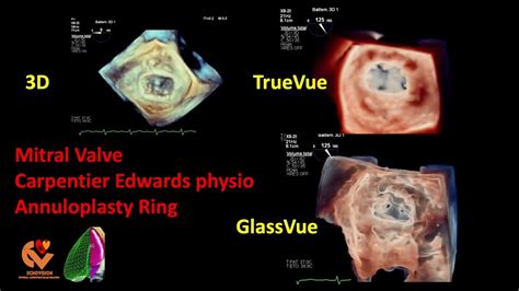 Mitral Valve Carpentier Edwards Physio Annuloplasty Ring Youtube