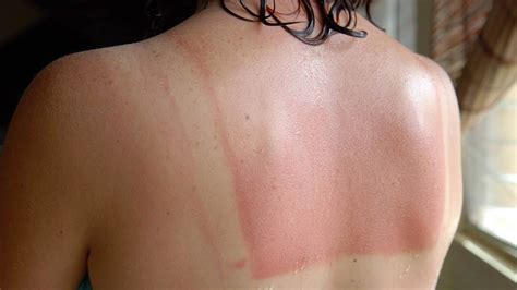 Sunburn Treatment What Works Mayo Clinic News Network