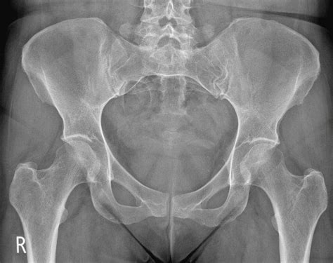 Ditulis oleh unknown senin, 14 oktober 2019 tambah komentar edit. Normal pelvic radiograph - female | Image | Radiopaedia.org