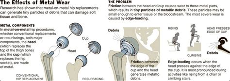 Defective Depuy Hip Replacements Signs And Symptoms
