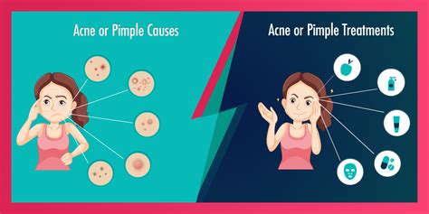 Acne Or Pimple Causes Symptoms And Treatments
