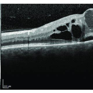 Macular OCT Showing Cystoid Macular Edema With Limited Subfoveal Download Scientific Diagram