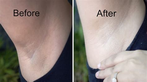 Body Whitening Cream Underarm Armpit Knee Dark Skin Bleaching Mo 【 限 定