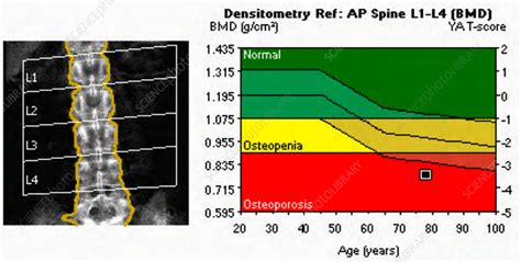Osteoporosis X Ray Bone Densitometry Stock Image C0393260