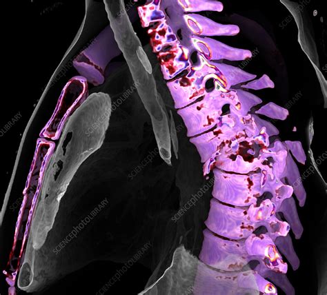 Thoracic Spine Fracture Ct Scan Stock Image C0582867 Science