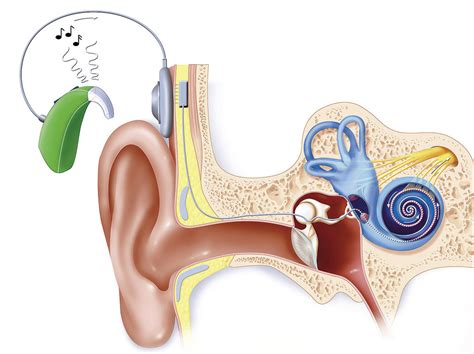 Cochlea Implantat Hno Ärzte Stellen Weißbuch Und Register Vor