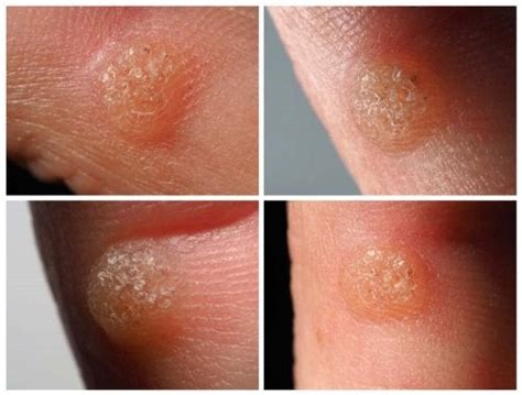 Types Of Warts And Treatments Illnesses Step To Health
