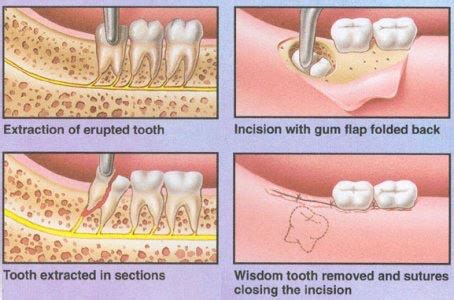 Next stop is your legs. How Are Wisdom Teeth Removed - Elite Dental Care Tracy - Elite Dental Care