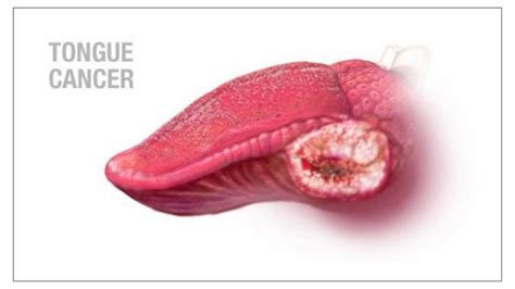 It often takes a few months for tongue cancer to develop the first noticeable symptoms. Mouth Cancer : Causes, Early Signs, Treatment, Diagnosis ...