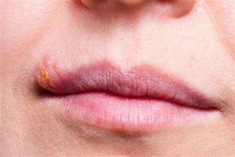 Have Spots And Sores On Your Mouth And Want To Know Why