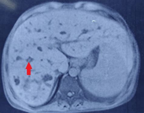 caroli s disease radiology sumer s radiology blog