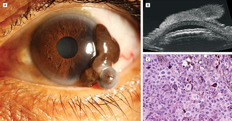 Conjunctival Melanoma External Eye Disease Jama Ophthalmology