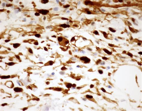Pathology Outlines Myxoinflammatory Fibroblastic Sarcoma