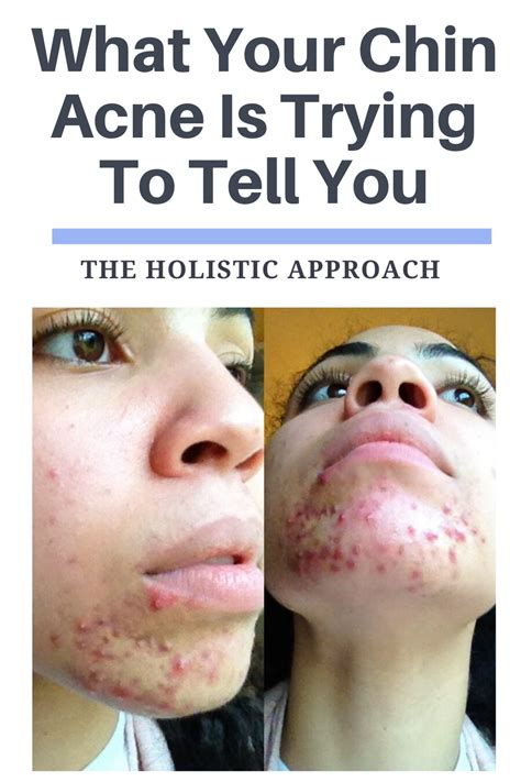 What Your Chin Acne Is Trying To Tell You Chin Acne Bad Acne How To