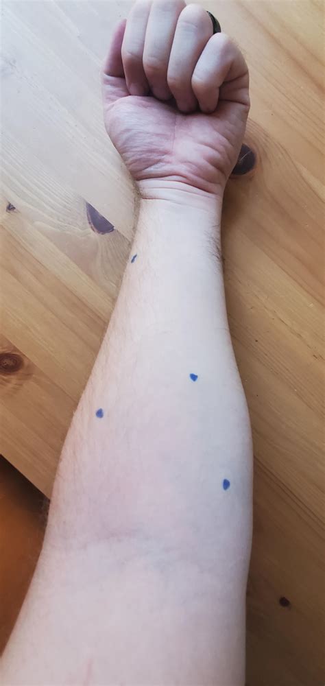 6 Pea Bb Sized Small Semi Firm Lumps Under Skin In My Forearm
