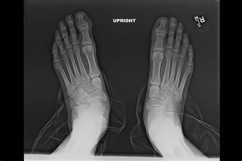 Case Report Chronic Foot Pain Accompanied With Deformity Clinical
