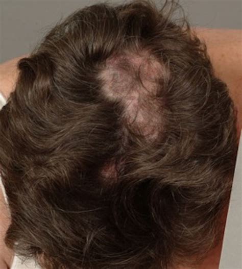 Alopecias In Lupus Erythematosus Lupus Science And Medicine