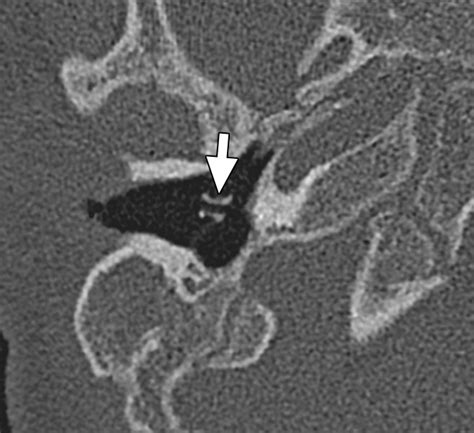 Imaging Review Of The Temporal Bone Part Ii Traumatic Postoperative