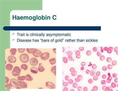 Ppt The Haemoglobinopathies Powerpoint Presentation Free Download