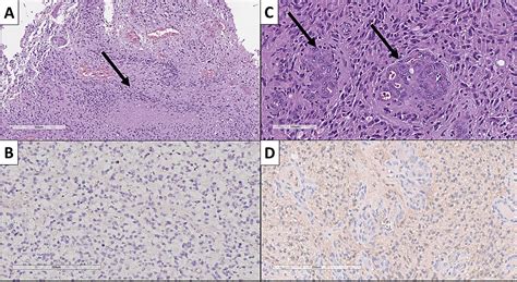 Cureus Reclassification Of Glioblastoma Multiforme According To The