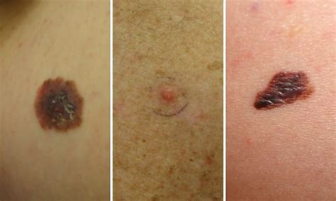 What Is Melanoma How To Tell If A Mole Is Cancerous Lovelyskin™