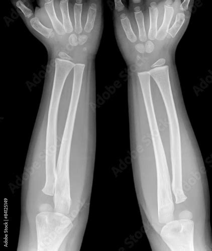 Film X Ray Forearm Show Normal Infants Bone Stock Photo Adobe Stock