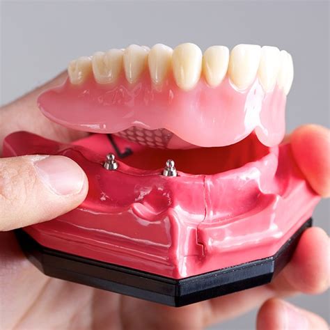 Dental Implant Dentures Houston Tx Missing Teeth Oral Surgeon