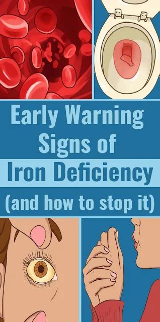 Signs And Symptoms Of Iron Deficiency Healthy Lifestyle