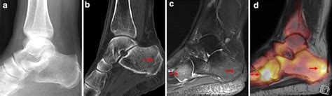 Muscle was closely related to the volume of all foot muscles determined by mri as described above. Visualization of stress fractures of the foot using PET-MRI: a feasibility study | European ...