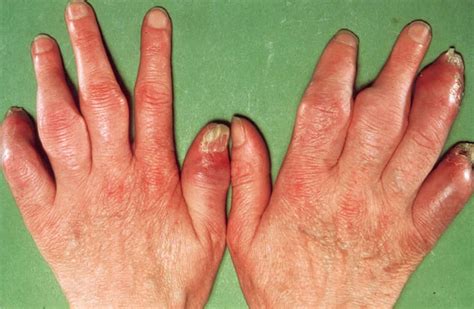 Dactylitis Causes Symptoms Diagnosis And Treatment