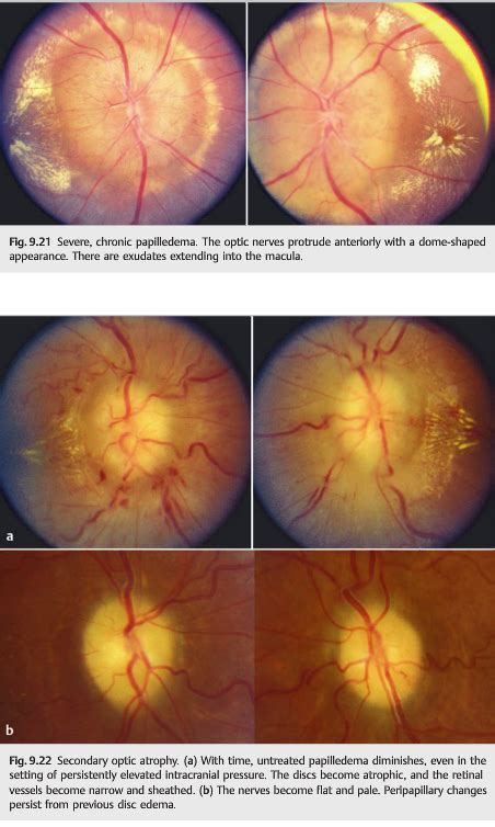 Neuro Ophthalmology Questions Of The Week Papilledema