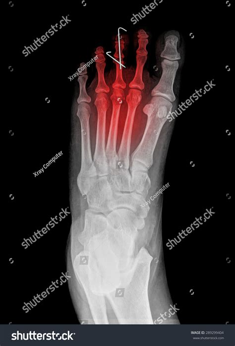 Top View Humans Feet Bones Under Stock Photo 289299404 Shutterstock